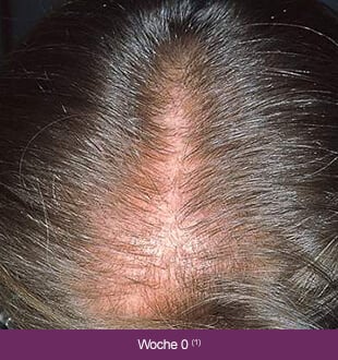 Regaine Frauen – Therapieverlauf nach 0 Wochen: Lichtes Haar