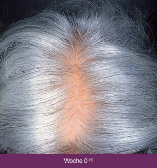 Regaine Frauen – Therapieverlauf nach 0 Wochen: Lichtes, graues Haar.
