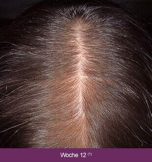 Regaine Frauen – Therapieverlauf nach 12 Wochen: Deutlich volleres Haar.