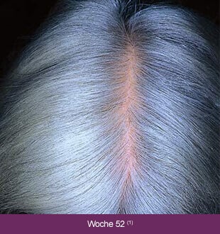 Regaine Frauen – Therapieverlauf nach 52 Wochen: Deutlich volleres, graues Haar.