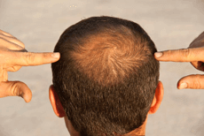 Mann zeigt auf seinen Haarverlust